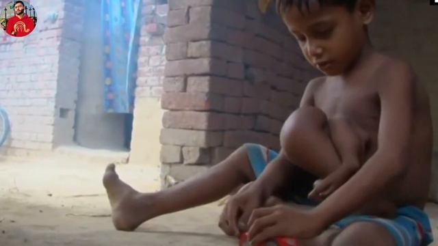 Indian Boy With Parasitic Twin Healed 😯 'Deepak Paswan' смотреть онлайн