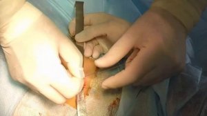 Паховая грыжа справа