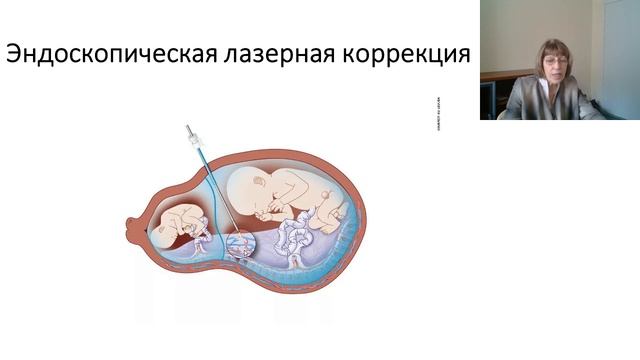 Многоплодная беременность 52 мин.mp4 смотреть онлайн