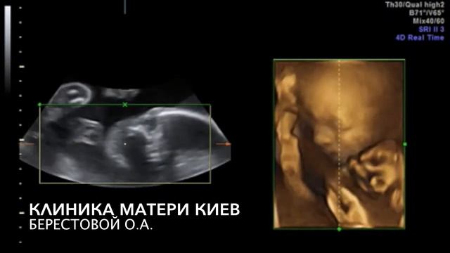 ЭТО ВИДНО НА УЗИ!!!!, У малыша что-то болит, Четко видна "ГРИМАССА БОЛИ" смотреть онлайн