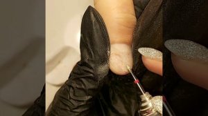 Онихолизис. Протезирование с помощью геля GEHWOL.