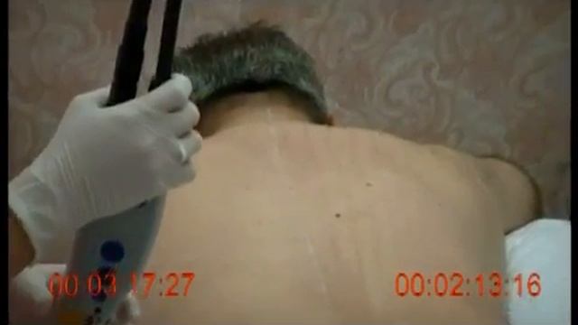 MedioStar NeXT vs Candela GentleLase смотреть онлайн
