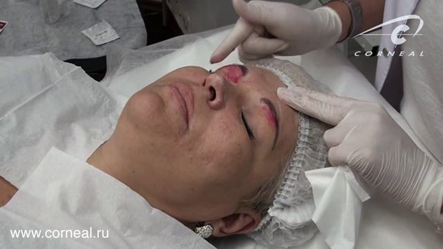 Пилинг для глаз - терпимо и эффективно смотреть онлайн
