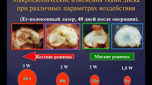 профессор Басков А.В. Доклад "Лазерная реконструкция межпозвонковых дисков" смотреть онлайн