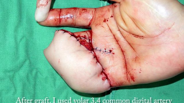 Reconstruction of multiple degloving fingers with ALT free flap and serial divisions. смотреть онлайн