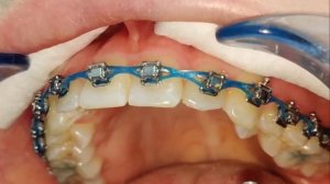 как же снимают брекеты?!