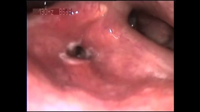 False Vocal cords Ложные связки смотреть онлайн