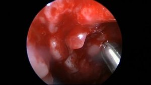 Эндоскопическое удаление аденоидов