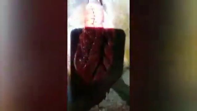 Закупорка большой ободочной кишки целлофановыми пакетами смотреть онлайн