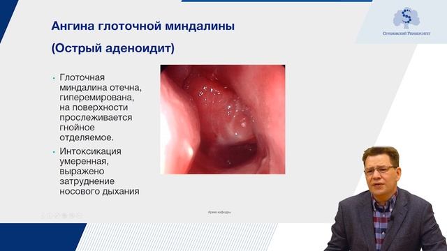 Острые заболевания глотки смотреть онлайн