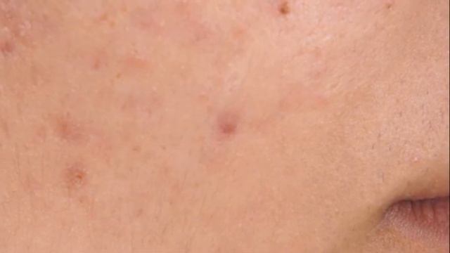 Какой орган отвечает за прыщи