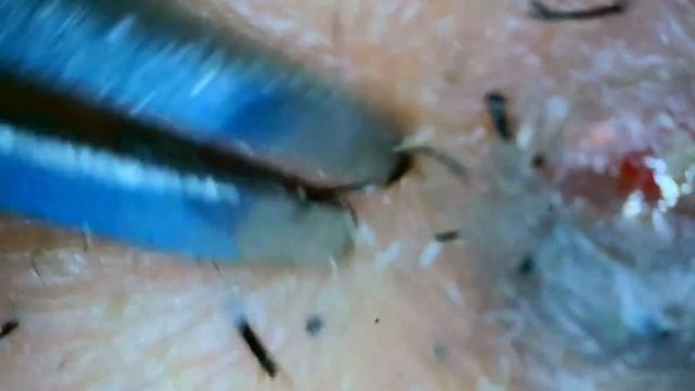 Popping huge blackheads and Pimple Popping - Best Pimple Popping Videos #40 смотреть онлайн