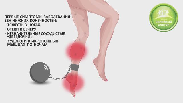 Современные методы лечения варикозной болезни смотреть онлайн