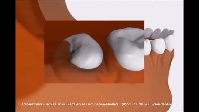 Прорезывание зуба мудрости смотреть онлайн