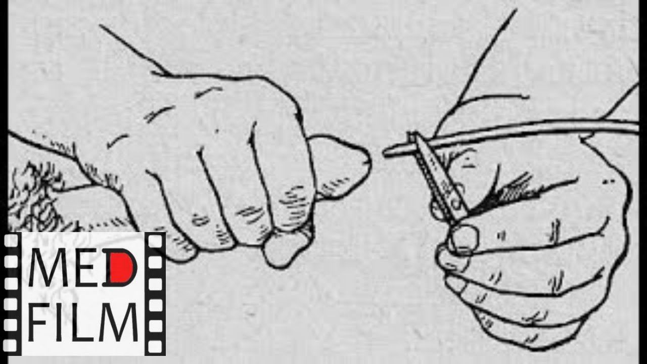 Катетеризация мочевого пузыря © Urinary catheterization смотреть онлайн