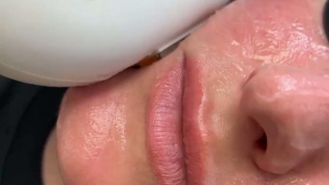 Лікування куперозу ЕЛОС лазером ? смотреть онлайн