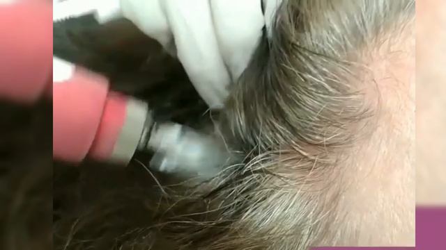 Дермапен в борьбе против выпадения волос смотреть онлайн