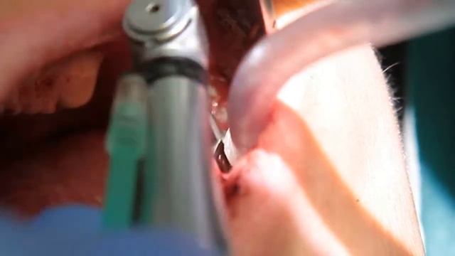 Удаление фиксирующих винтов трансплантатов на нижней челюсти, дентальная имплантация смотреть онлайн