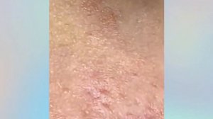 ? Выдавливание прыщей | Удаление и выдавливание прыщей и черных точек 2021 | Прыщи выдавливание #01