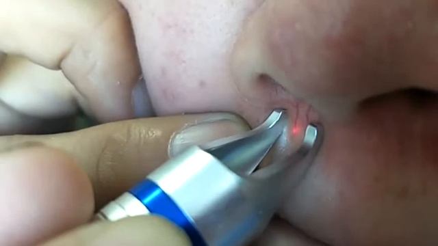 диодный лазер 980nm для удаления сосудистых звездочек ( 980nm vascular removal video смотреть онлайн