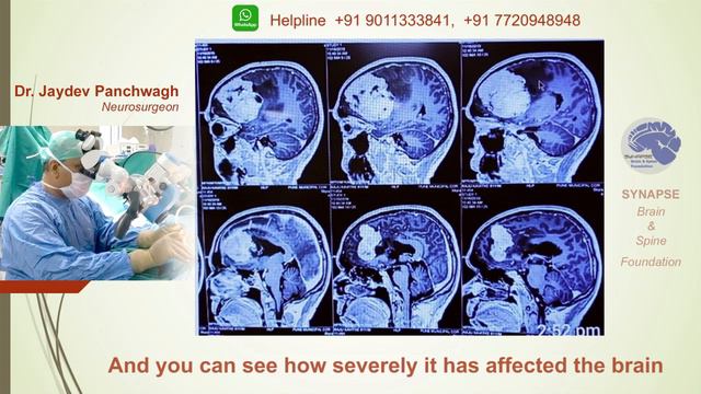 #4. Brain tumors-Incredible stories of survival. Dr Jaydev Panchwagh смотреть онлайн