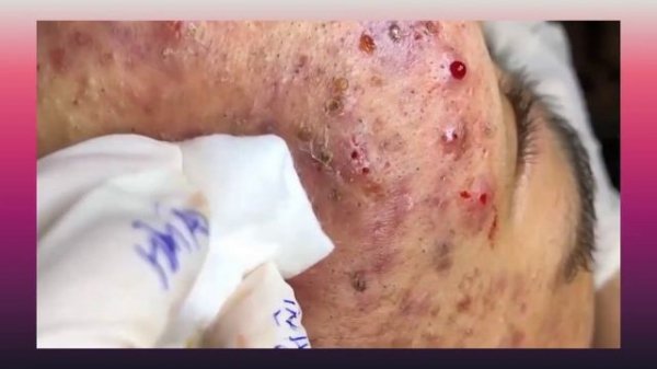 Professional bleckheads   Выдавливание черных точек прыщей   самое залипательное видео 2022