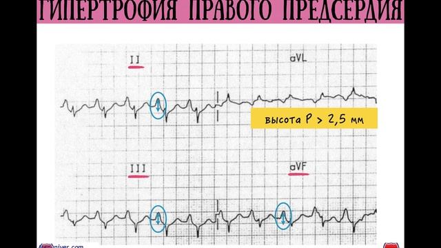 Расшифровка ЭКГ при гипертрофии предсердий