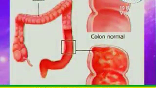 La colitis ulcerosas: Inflama el intestino grueso смотреть онлайн