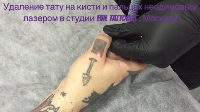 Удаление татуировки на кисти неодимовым лазером #удалениетату #удалениетатуаж #лазерноеудалениетат смотреть онлайн
