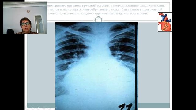 Кардиомиопатия смотреть онлайн