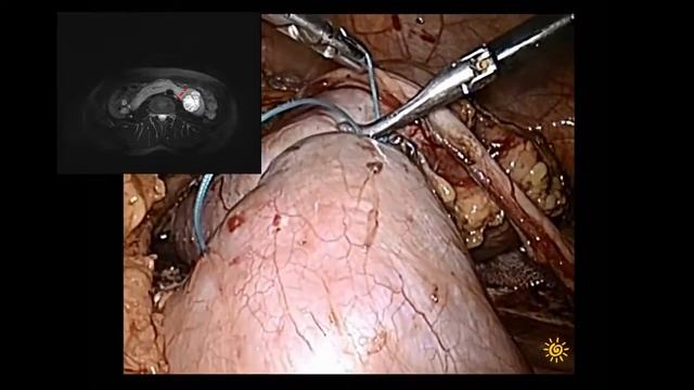 Horseshoe kidney lap partial nephrectomy/подковообразная почка лапароскопическая резекция смотреть онлайн
