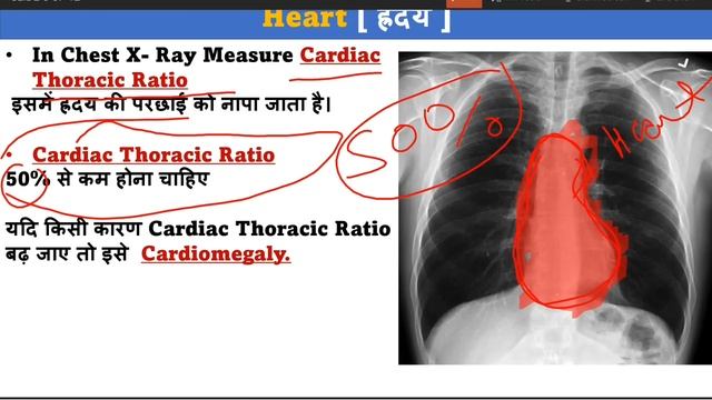 Chest X Ray | X Ray | X Ray Reading | Pneumonia | Lungs Effusion | X Ray Technician | Doctor | bhms смотреть онлайн