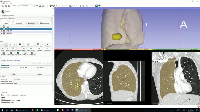 Organ segmentation 3.1 : Lungs, lobes, volumetry смотреть онлайн