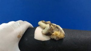 BEST Pimple Popping // Big Cystic Acne Blackheads // Whiteheads Removal / Squeezing Pimples / Hr#09