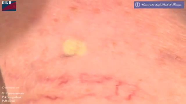 Tratamente vasculare cu laserele DEKA Nd YAG laser смотреть онлайн