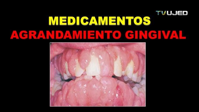 GINGIVITIS Y PERIODONTITIS CARACTERISTICA Y TRATAMIENTO смотреть онлайн
