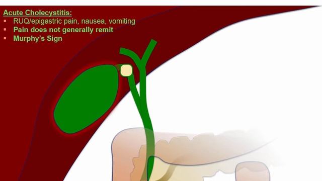 Express Video of the Week: Gallstones (cholelithiasis) смотреть онлайн