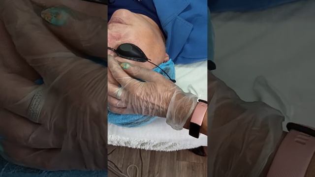 Лазерное удаление некачественного татуажа бровей... Светлана Яковенко Оренбург смотреть онлайн