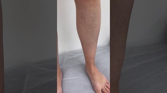 Сосудистая сетка. Планируем удаление. Склеротерапия. Флеболог Москва. Флеболог смотреть онлайн