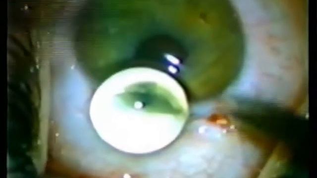 Ю Эс Оптикс - имплантация ИОЛ US-301 смотреть онлайн