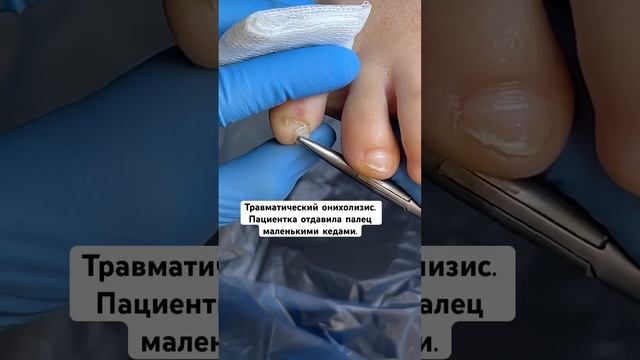 ОТДАВИЛА ПАЛЕЦ МАЛЕНЬКИМИ КЕДАМИ ? #онихолизис #травмапальца #подолог #подология смотреть онлайн