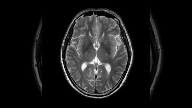 HN C9 Ethmoidal and Sphenoid Mucocele (B) смотреть онлайн