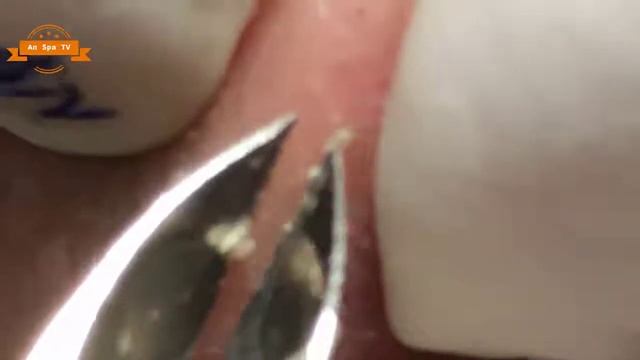 Удаление прыщей с носа и щек Spa #071 смотреть онлайн