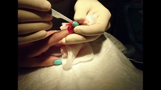 Удаление ногтевой пластины - Персона Мед смотреть онлайн