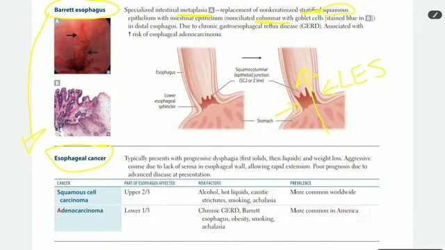 Up To Date - GIT PATHOLOGY ( part 3 ) [ Barrett esophagus & esophageal Cancers ] смотреть онлайн