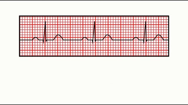 Corrected QT interval (QTc) calculation with Bazett's formula смотреть онлайн