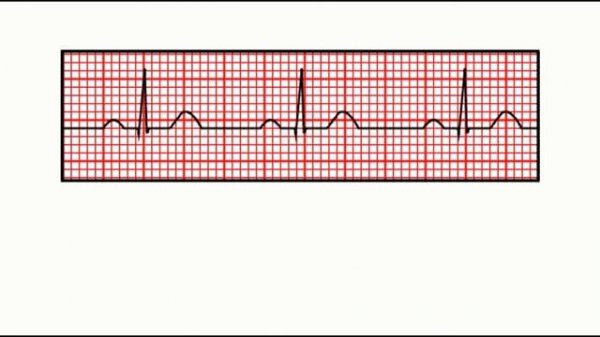 Corrected QT interval (QTc) calculation with Bazett's formula