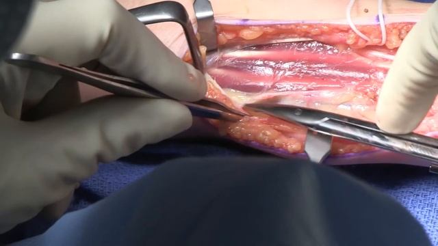3rd Webspace to Sensory Component of Ulnar Nerve Transfer - Extended (Feat. Dr. Mackinnon) смотреть онлайн