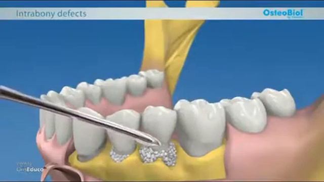 OsteoBiol Gen Os смотреть онлайн