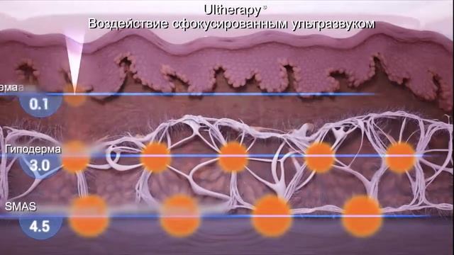 Как работает ультразвуковой лифтинг Ulthera System (Альтера)?